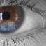 oftalmologo malaga degeneracion macular