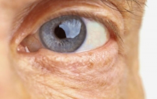 oftalmologo malaga cirugia cataratas