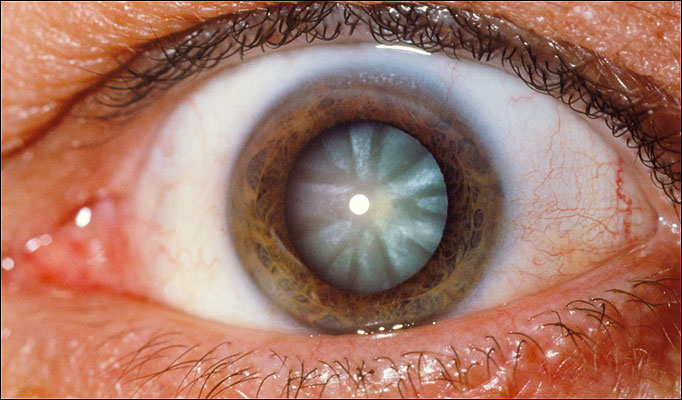 oftalmologo malaga tratamiento cataratas