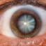oftalmologo malaga tratamiento cataratas